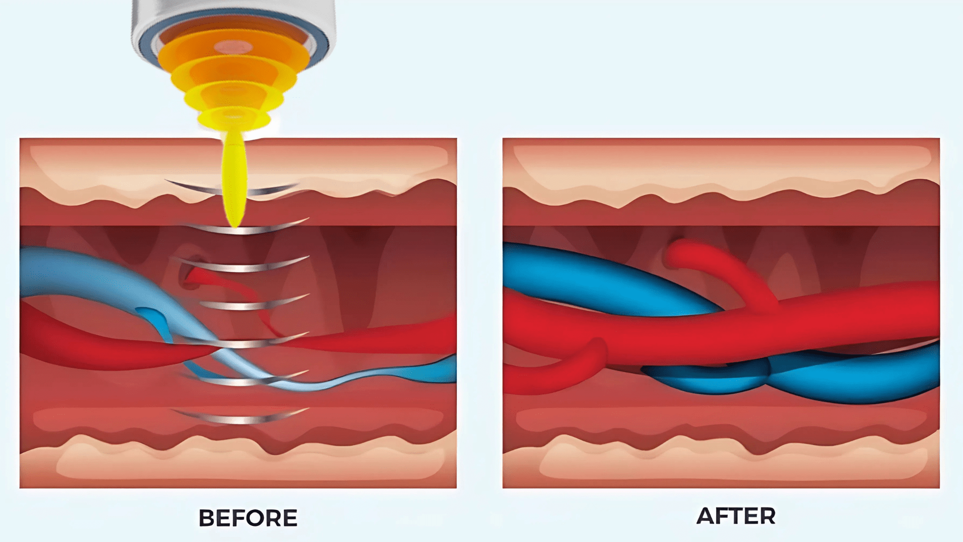 ed wave thearpy before and after